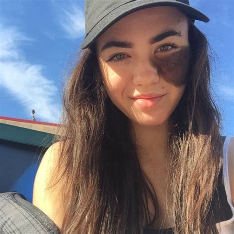Cassandra Naud was born with a hairy birthmark under her left eye.
